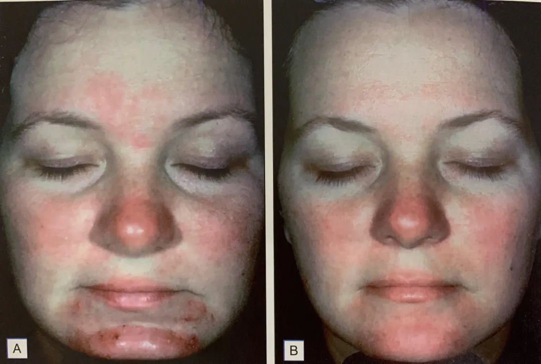 What Is AHA In Skincare