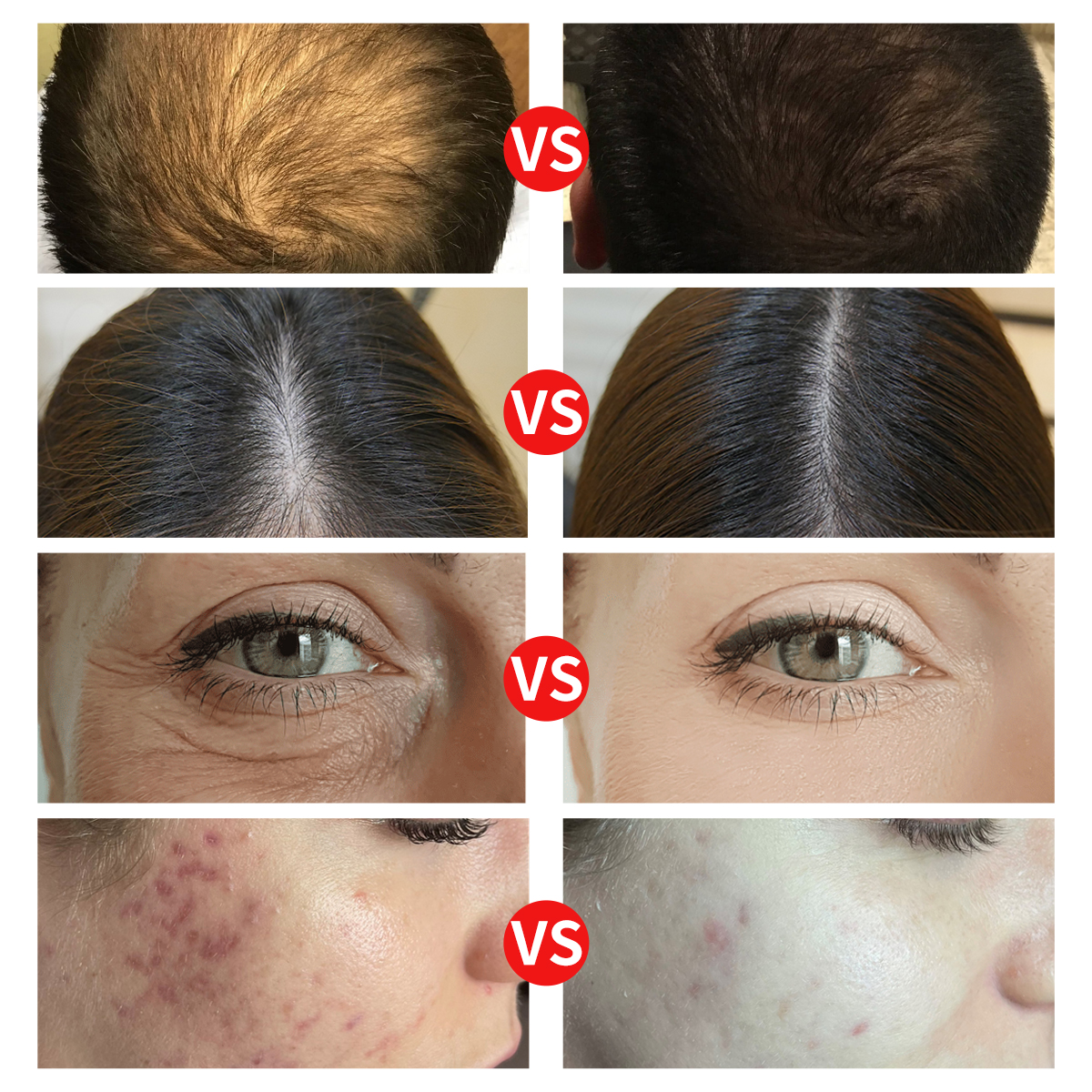 Private Label Micro Infusion System Microneedling Serum Kit for Face