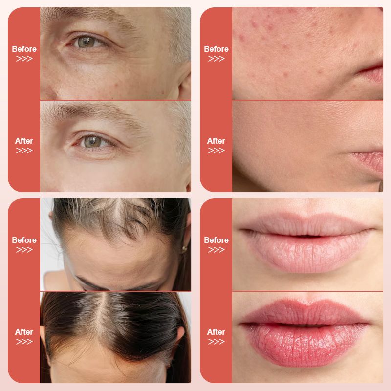 Electric hydra pen for face